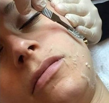 dermaplaning pic