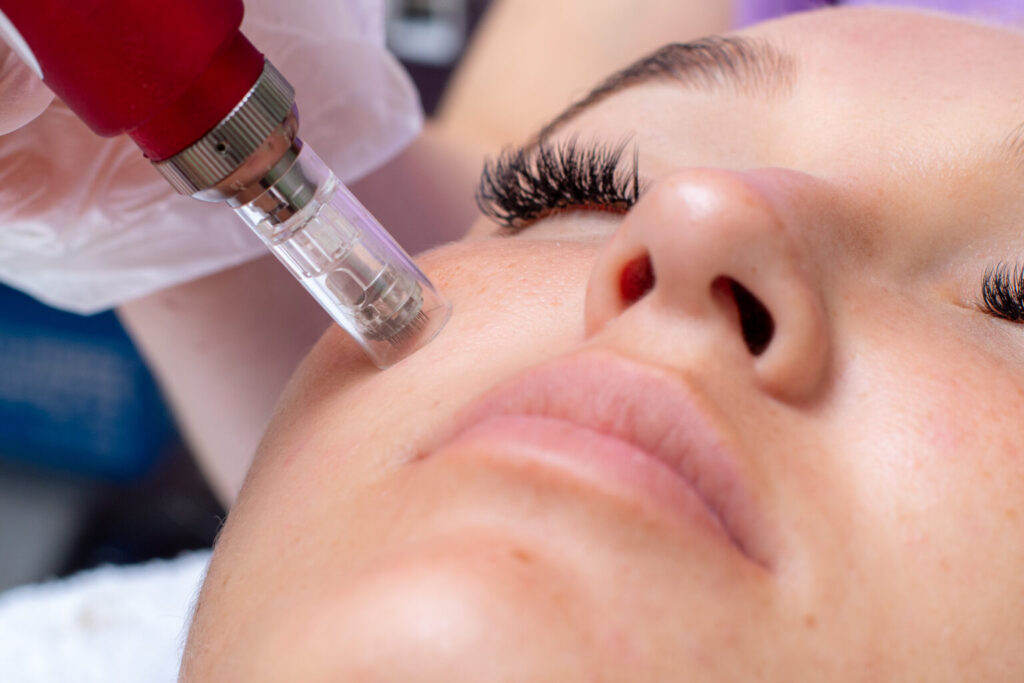 Microneedling facial services near me